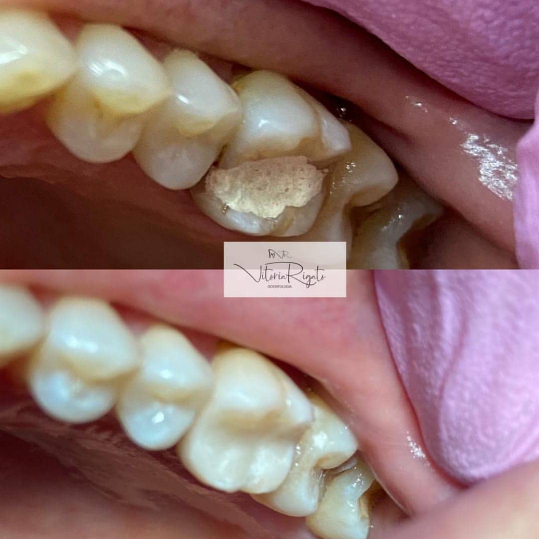 Correção e Estética Funcional (antes e depois)